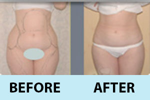 liposuction