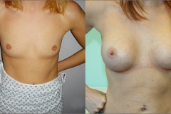 Breast Augmentation