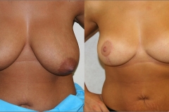 Breast Reduction