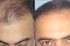 Hair Transplantation