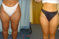 Liposuction