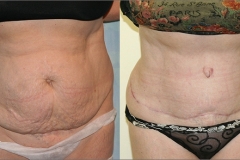 Tummy Tuck